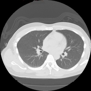 胸部CT肺野画像