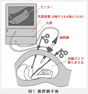 腹腔鏡手術