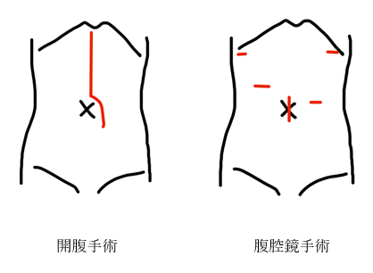 図3　胃がん手術における開腹と腹腔鏡の傷の違い