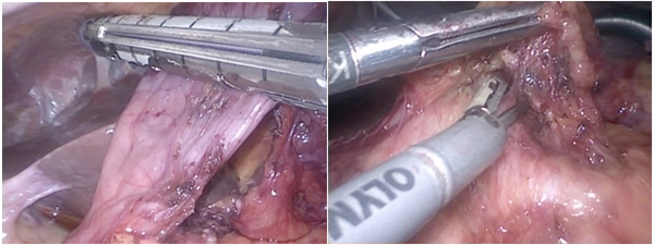 図４　腹腔鏡下胃切除術