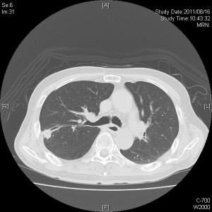 肺癌肺野CT
