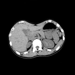 正常の腹部CT画像