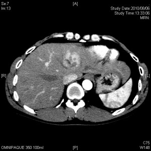 肝臓癌の造影CT画像