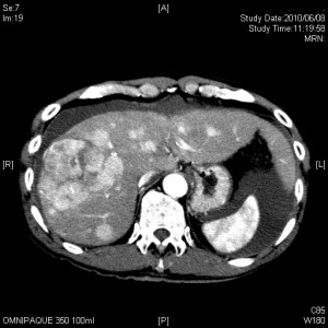多発性肝臓癌の造影CT画像