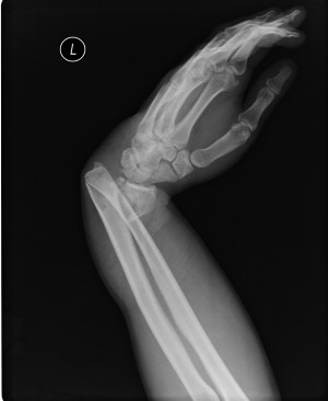手関節の骨折側面