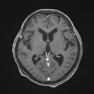 造影頭部MRIAx