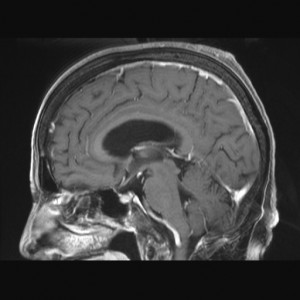 造影頭部MRISag