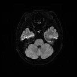 正常の橋部MRI-Diffusion画像