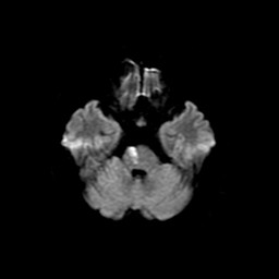 脳梗塞のMRI画像