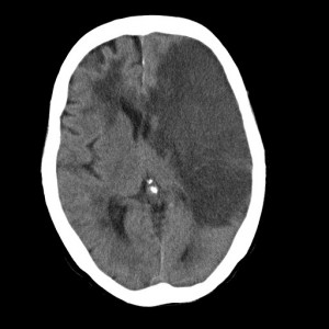 脳梗塞発祥1週間後のCT画像