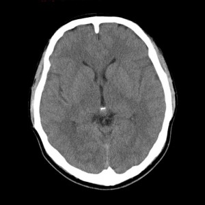 正常の頭部CT画像