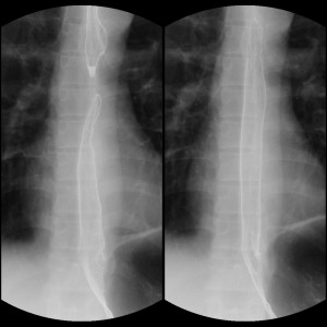 正常の食道画像