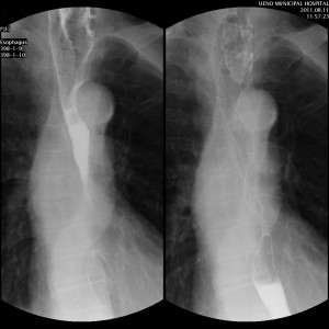 食道癌の透視画像
