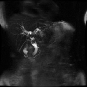 総胆管結石のMRI画像