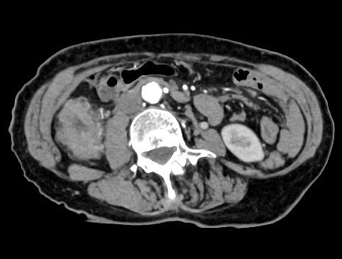 CT装置で撮影した腹部の厚さ0.5mm
